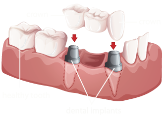 Implant Supported Bridges