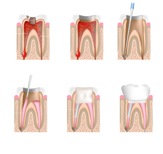 Everett Root Canals